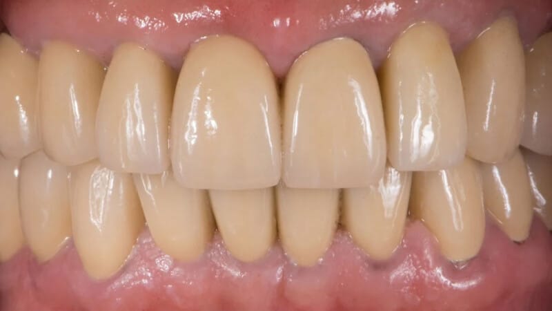 dupa implant incisiv