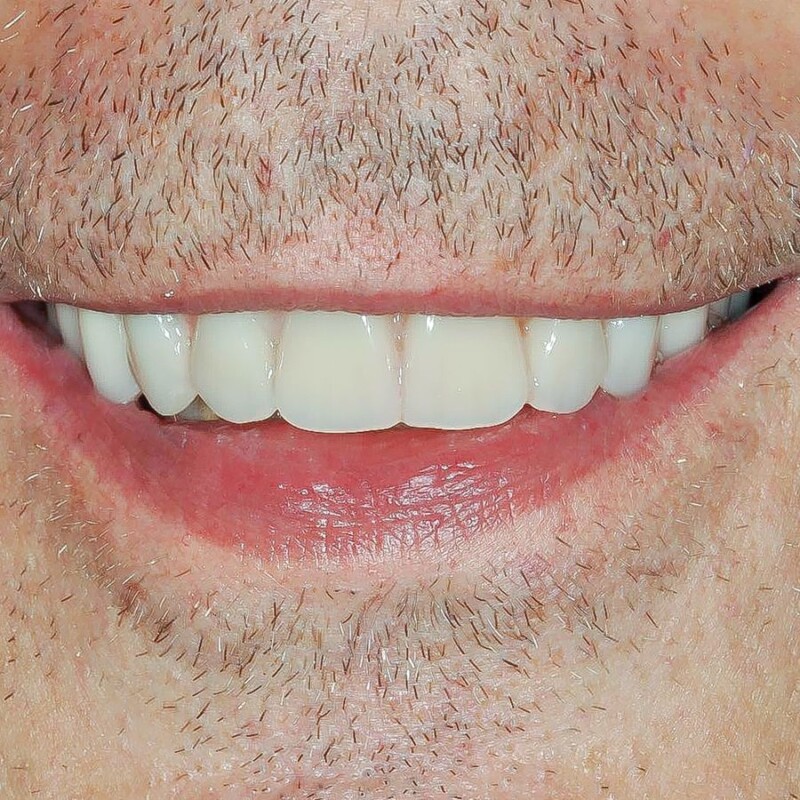 cazul 1 - dupa implant dentar