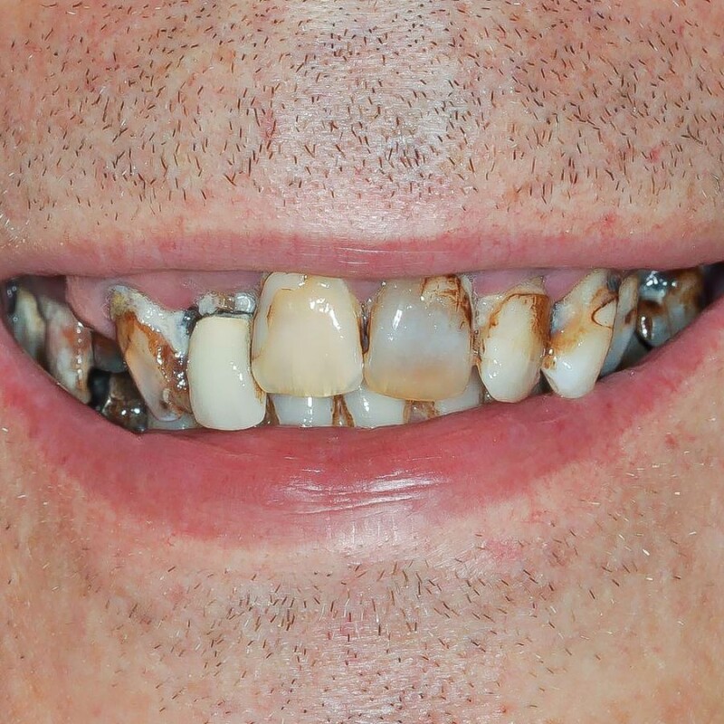 cazul 1 - inainte de implant dentar