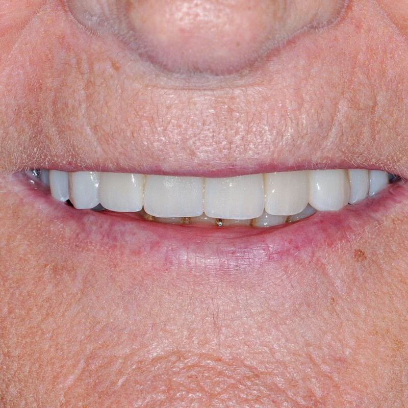 cazul 2 - dupa implant dentar
