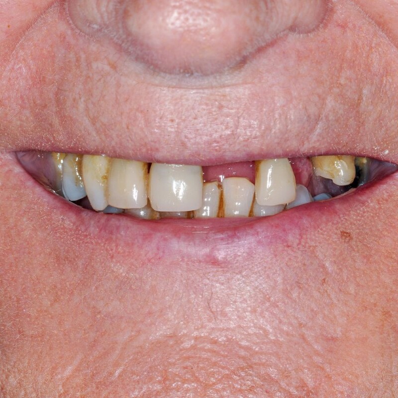 cazul 2 - inainte de implant dentar