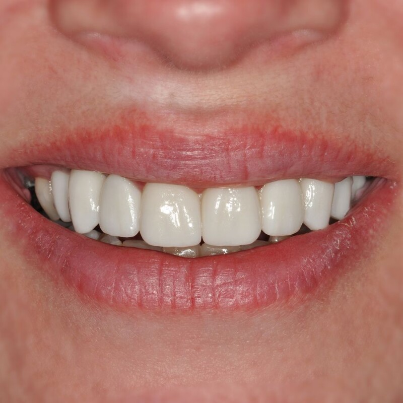 cazul 3 - dupa implant dentar