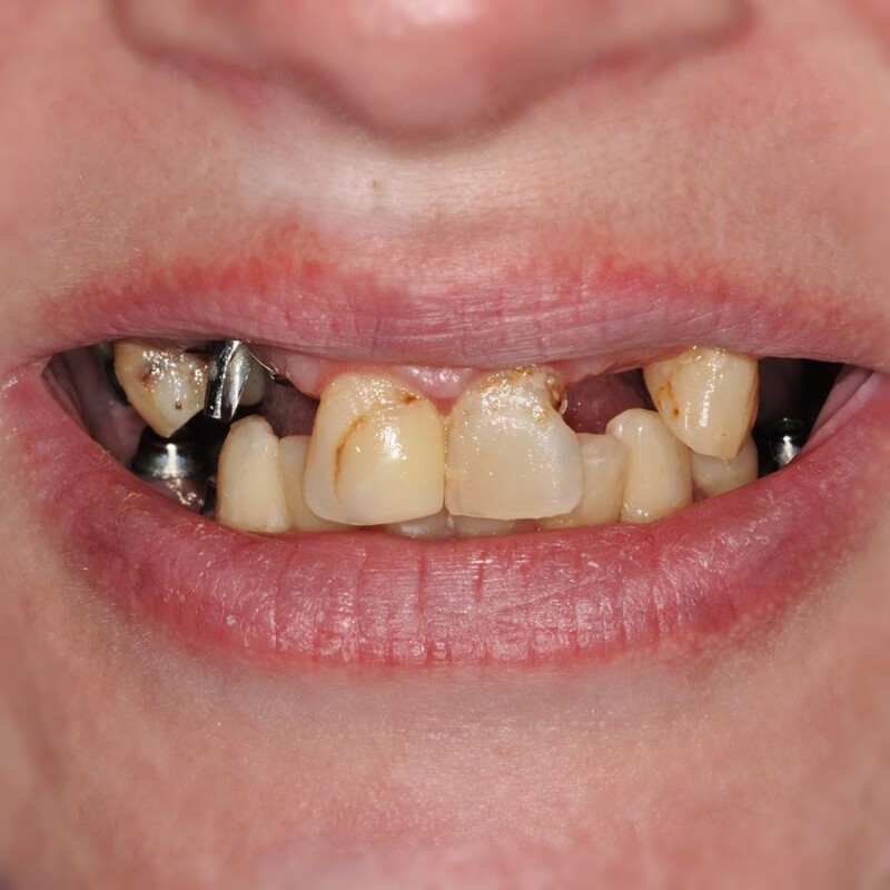 cazul 3 - inainte de implant dentar
