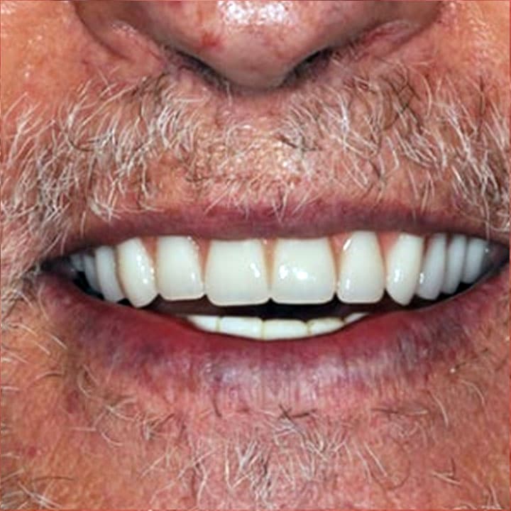 cazul 4 - dupa implant dentar