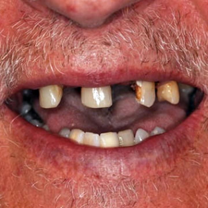 cazul 4 - inainte de implant dentar