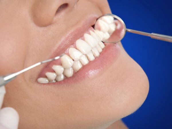 Cazuri în care e nevoie mai frecvent (parodontită, fumat, aparat dentar)