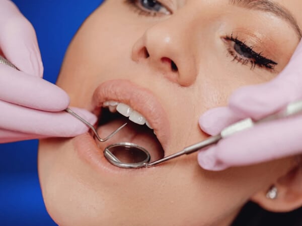 Fluorizare dentară
